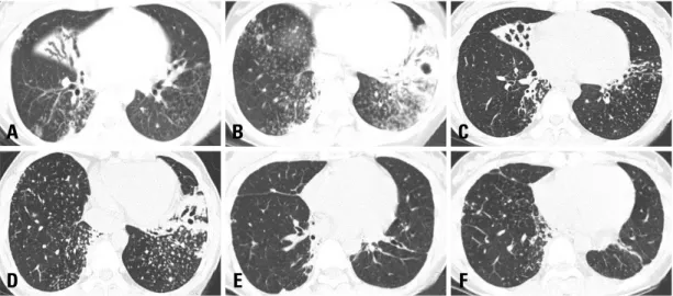 Fig. 1. High-resolution computed tomography (HRCT) on admission showed the collapse with bronchiectasis of right middle lobe, cavitary lesion of left lower lobe, and multiple branching linear opacity on both lower lobes (A and B)