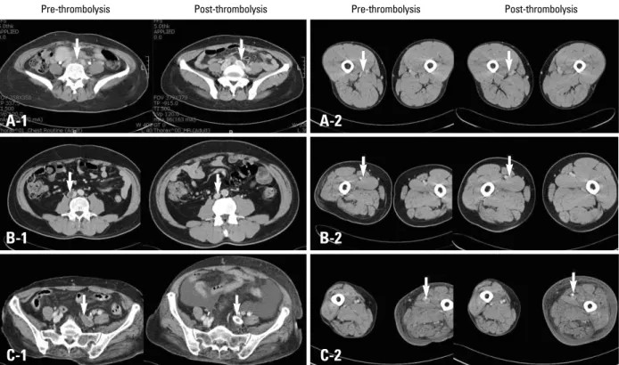 Fig. 1. MDCT angiograms showing complete thrombus removal (A), partial thrombus removal (B), and treatment failure (C)