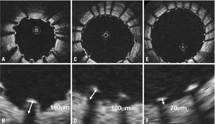 Fig. 1. Measurements of strut apposition. The distances between the endo-luminal surface of the strut reflection and the vessel wall were measured