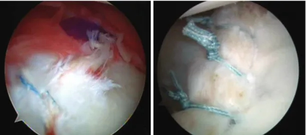 Fig. 1. (A) Arthroscopic photograph after trauma shows a pull out of the suture anchor