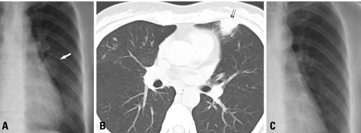 Fig. 1. A 45-year-old woman with NB-MAC, initially presenting with consolidation. (A) Plain chest radiography shows an ill-defined ovoid consolidation in left middle lung zone (arrow)