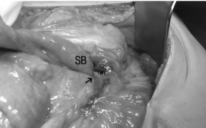 Fig. 3. Intraoperative view from the root of the transverse mesocolon reveals the hernia orifice (narrow arrow) through which the small bowel (SB) herniated.