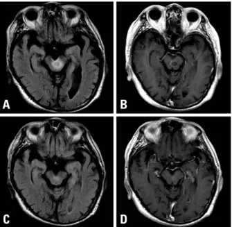 Fig. 1. Brain MRI. (A) Initial FLAIR image shows high signal intensity on left midbrain and perilesional edema