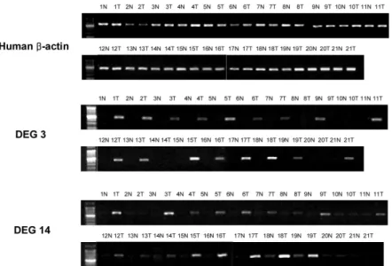 Fig. 5. In 21 PTC samples by RT-PCR,  DEG3 and DEG14 were observed to be  up-regulated in most tumors