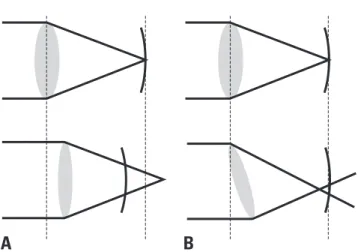 Fig. 1. Possible anatomic changes after cataract surgery in eyes with angle closure glaucoma