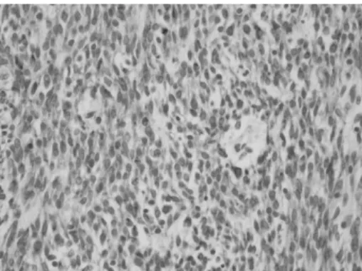 Fig. 6. Immunohistochemically, the cytoplasm of tumor cells tests diffusely positive for c-kit.