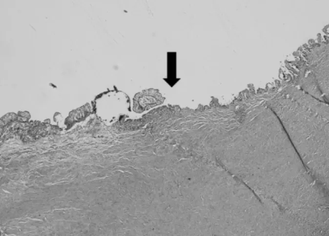 Fig. 4. Microscopic finding of the junction of the seminal vesicle and remnant ureter in case 3