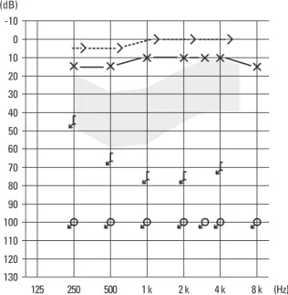 Fig. 1. The pure tone audiogram showing that the hearing level in the right ear had scaled out at all frequencies