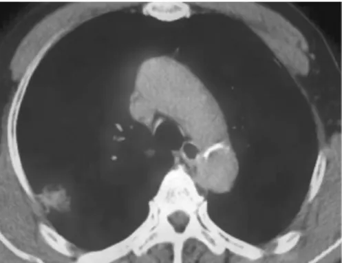 Fig. 2. PET-CT scan showed an abnormal hypermetabolic uptake in right upper lobe of lung.