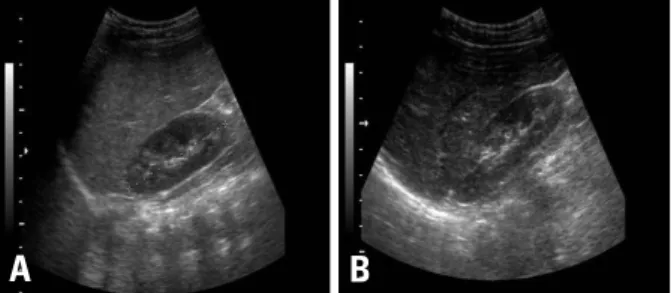 Fig. 3. Comparision of sonographic findings between first time (A) and 14 months later (B)