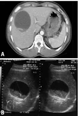 Fig. 1. (A) Computed tomography of the abdomen with contrast medium showed a low-density cystic mass, measuring 9×8 cm, in the right hepatic lobe