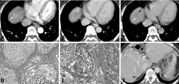 Fig. 1. A 56-year-old female with early recurrent HCC after segmentectomy. The AFP level in a blood sample obtained on the same day as the CT scan was 1076.84 IU/mL