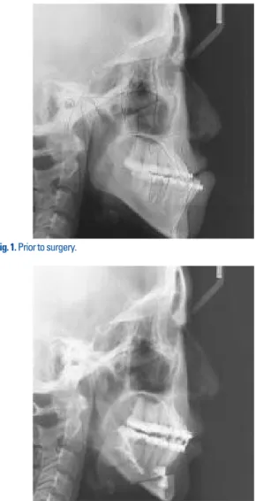 Fig. 4. At the time of diagnosing dentofacial deformity, a line forming a 6-7° slope to the FH plane or SN plane was most frequently used as the transverse baseline