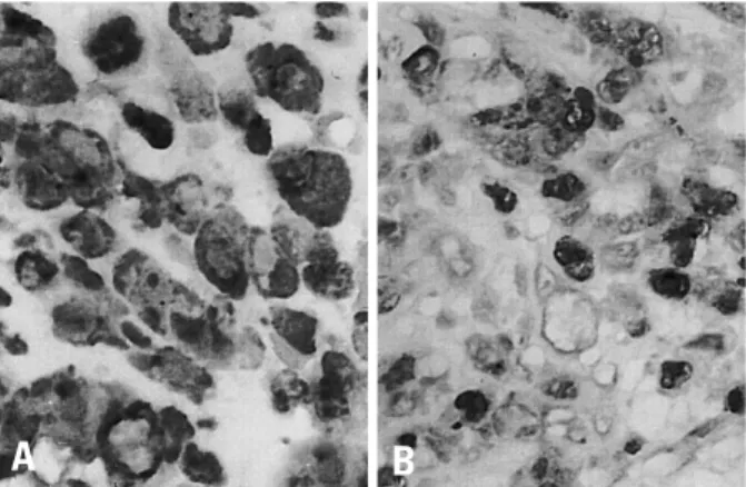 Fig. 3. Noncohesive, infiltrative and widespread single tumor cells at the edge of the tumor (H&amp;E, original magnification×100).