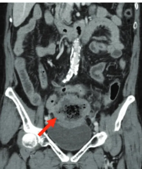 Fig. 1. CT:  wall thickening with central necrosis in small bowel and lympha- lympha-denopathies near the mass.