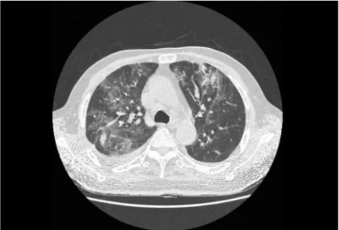 Fig. 1. Computed tomography of the chest, showing new bilateral patchy ground-glass opacities.