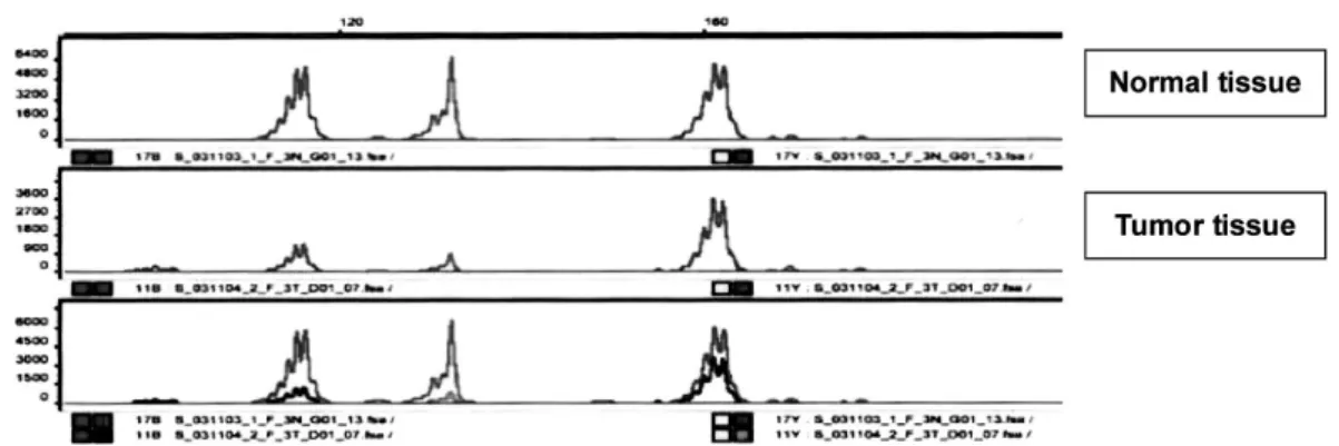 Fig. 1. Example of microsatellite analysis comparing normal DNA and tumor DNA. A case shows microsatellite instability (MSI) at BAT26.