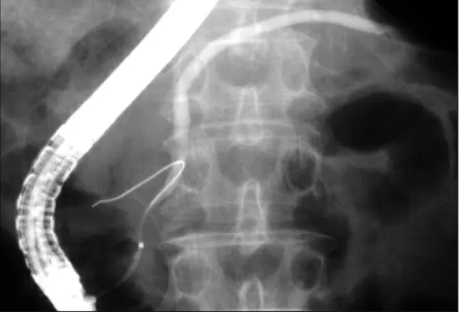 Fig. 1. Upper gastrointestinal endoscopy revealed a flat elevated tumor with central ulceration in the 2nd portion of the duodenum.
