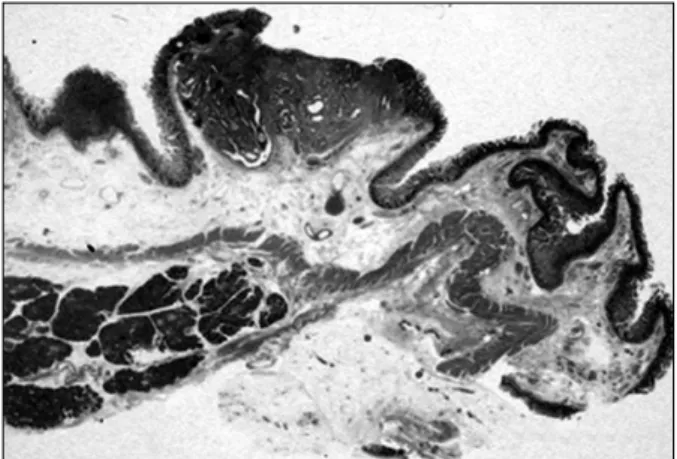 Fig. 6. Microscopic findings showed no infiltration into the pancreas parenchyma. (Hematoxylin Eosin staining, original magnification × 3).