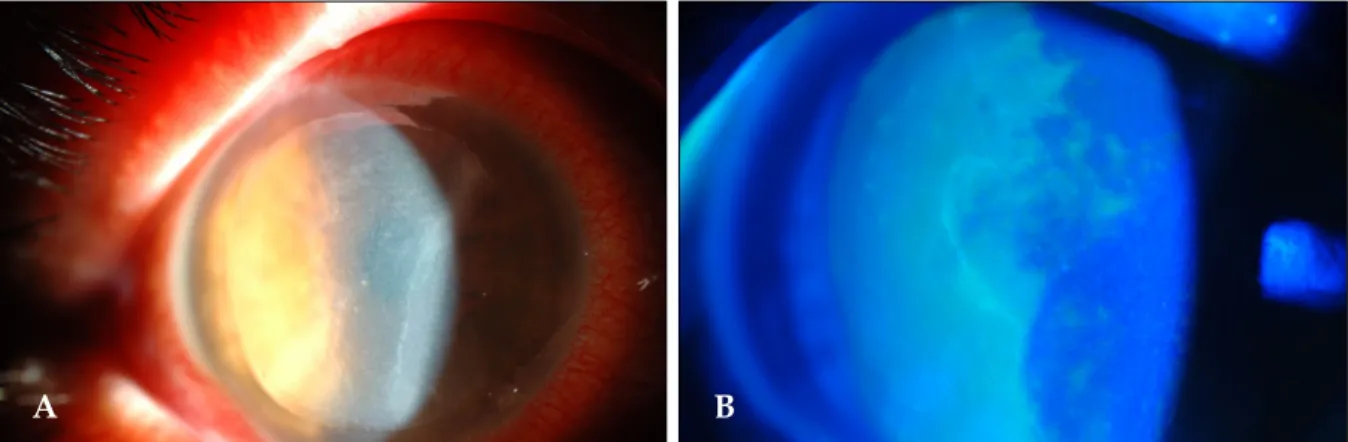 Fig. 1. On initial examination in our clinic, there were irregular opacities underneath the flap