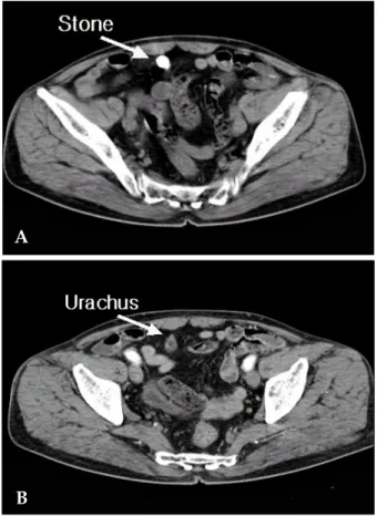 Fig. 3. Gross finding of the urachus and bladder cuff shows an inflammed urachal cyst containing two stones (dot area).