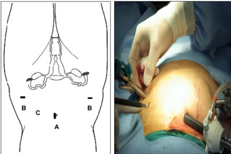 Fig. 3. Port placement: (A) The 12-mm camera port was placed in the umbilicus or above depending on the size of the uterus