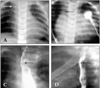 Fig. 1. Plain chest radiographs showed a bulged contour (arrow) at the right upper cardiac border of a  4.5-month-old male (A), and deviations (arrow) of the trachea in a 16-day-old male (B)