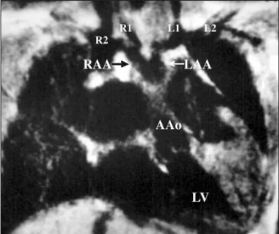 Table 1. Diagnosis of the Double Aortic Arch and Its Differentiation from the Conotruncal Malformations