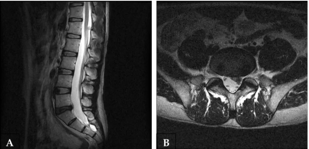Fig. 1. Spinal cord tumor in the thoracolumbar junction with a comorbid herniated lumbar disc.