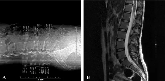 Fig. 2. Spinal cord tumor that was misdiagnosed as benign back pain. (A) The scout view of the lumbar computerized tomographic scan was taken in a private clinic in September 2004
