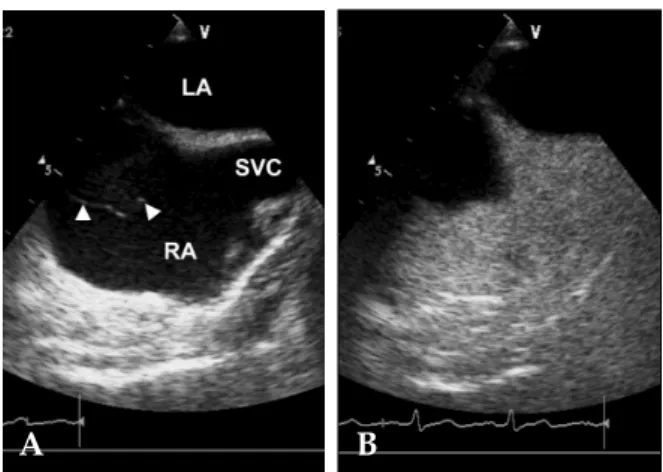 Fig. 1. Enhanced computed tomography imaging showing a slightly enhancing homogenous round mass with low density in the right atrium.