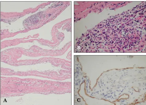 Fig. 4. Photomicrographs. (A) Col- Col-lapsed and infolded cyst wall (H&amp;E, × 40). (B) Higher power view of cyst wall structure, showing loose  connec-tive tissue stroma lined by flat  endo-thelial cells beneath which is seen a lymphocytic infiltration 