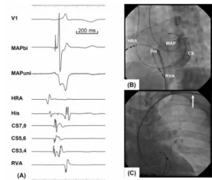 Fig. 2. Surface lead electrocardiograms and intracardiac electrograms during the baseline (A), ventricular pacing at a cycle length of 320 ms (B) and a supraventricular tachycardia (C)