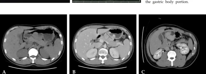 Fig. 1. (A) Endoscopy showed a large submucosal tumor in the  gas-tric body with bleeding from a large central ulceration that contained fluid and residual contrast material from a previous barium study