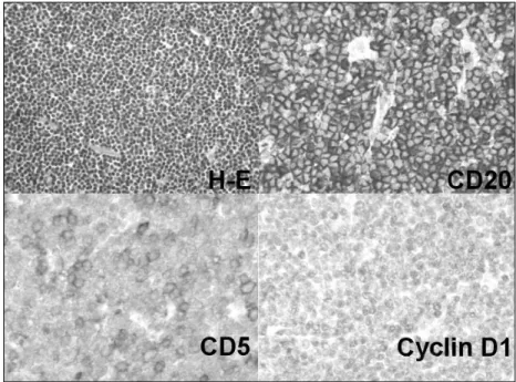 Fig. 5. The lymphocytes are small and monotonous (H&amp;E, × 200), which are positive for CD20, CD5, and cyclin-D1 (× 400)