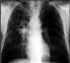Fig. 2. Chest PA shows pulmonary tuberculosis with a cavitary lesion in the right lung (Type II).
