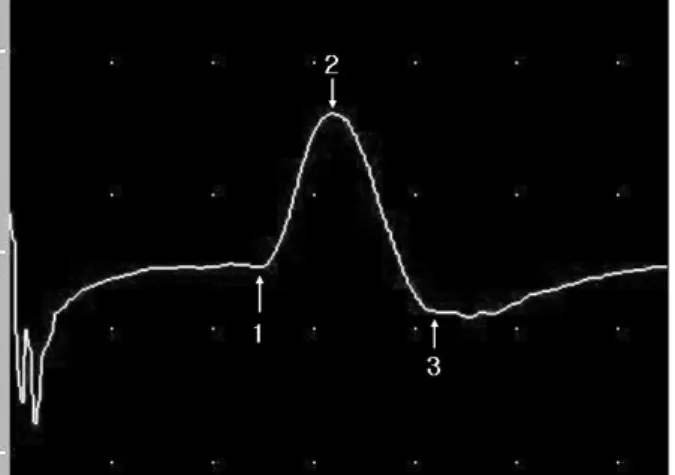 Fig. 1. Wave form markers: 1, onset latency; 2, peak latency; time from marker 1-3, duration; vertical distance from 1 (or 2)-3, peak to peak amplitude; area under the curve, from marker 1-3.