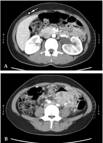 Fig. 2. Sigmoid colon is thickened and perforated about 1 cm in diameter.