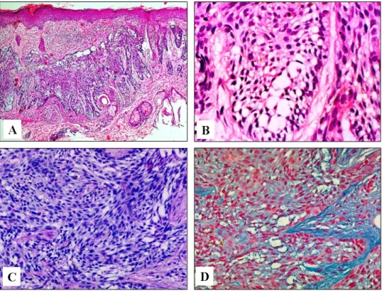 Fig. 2. Irregularly arranged basaloid cells and clear vacuolated cells with peripheral palisading of basaloid cells within infiltrating tumor lobules (hematoxylin and eosin, A, × 40; B, × 400)