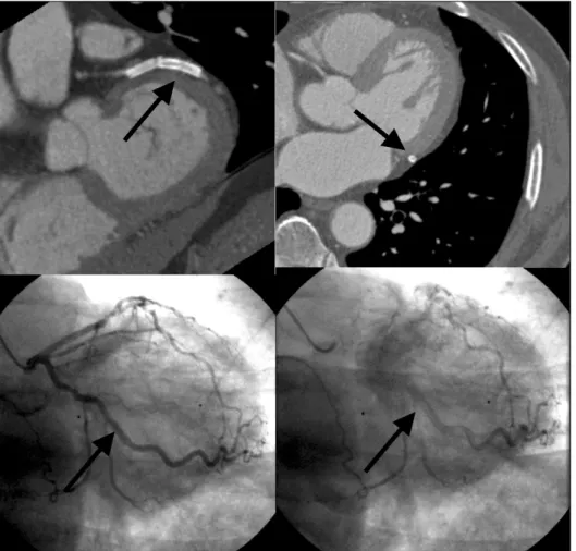 Fig. 4. Stent patency evaluation by MDCT. The stent patency evaluation was possible by a density measurement and a direct visual assessment in the lumen of the stent.