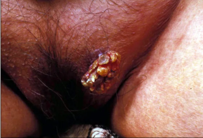Fig. 1. A verrucous and pedunculated mass on the left vulva.