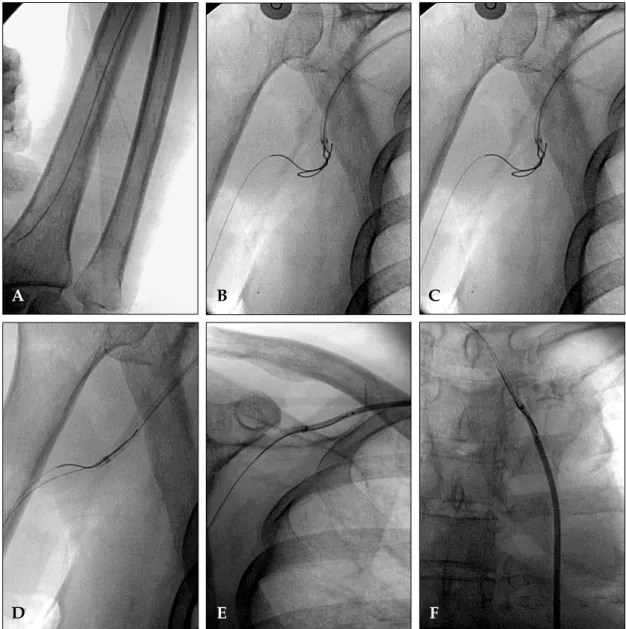 Fig 1. A. A broken 0.014" guidewire retained in a left radio-brachial artery. B. Retrieval using a snare was attempted several times but failed