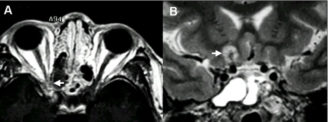 Fig. 1. Visual field defect (dark area) was noted in the whole area, except in the small inferomedial portion of the field, on the day of surgery (A)