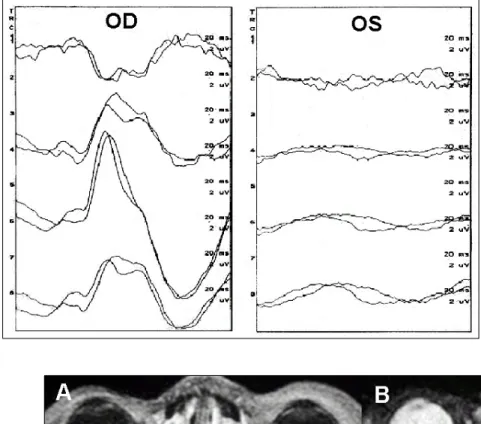 Fig. 3. Visual evoked potential test findings 8 days after sinus surgery. A flat wave for the left eye indicated complete loss of visual activity in Case 2.