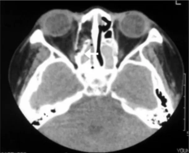 Fig. 5. Axial CT showing a small right medial wall fracture and a possible partial defect in the right optic nerve