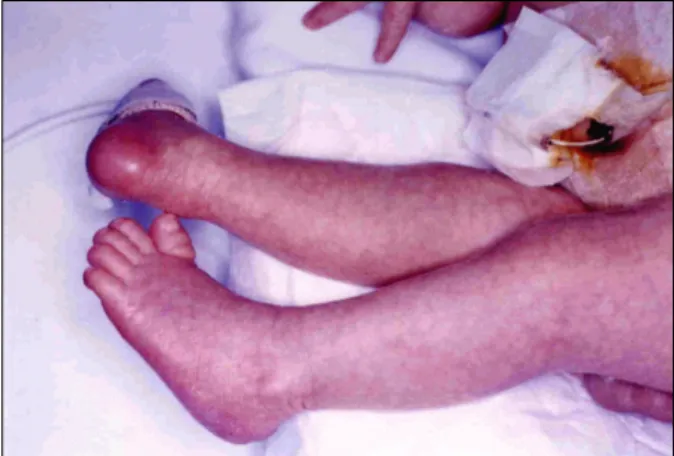 Fig. 2. Featureless lower extremities that are cylindrical with thin subcutaneous tissue and lack skin creases.