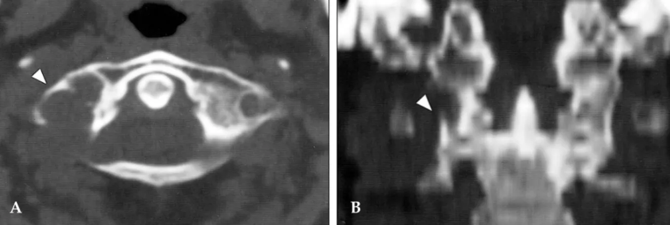Fig. 1. A and B: Pre-operative CT scan with bone setting reveals extensive erosion with marginal sclerosis in the right transverse process and superior articular facet of C-1 (white triangle).