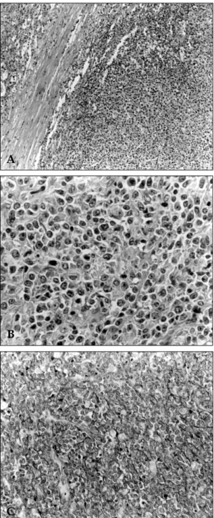 Fig. 3. Histopathologic findings of Case 1. A) Mass border on low power (×100) showing an expanding growth pattern of tumor cells