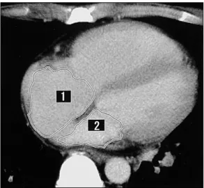 Fig. 4. Contrast-enhanced CT at the mid-ventricular level showed that the interventricular septum was straightened and the right ventricle and right atrium were dilated,  in-dicating a raised pressure on the right side of the heart.