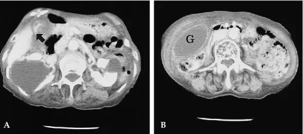 Fig. 1. A, B. Preoperative contrast-enhanced axial computed tomographic scan demonstrated a massively distended